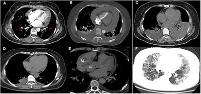 Case Report: Thromboembolism and Hemorrhagic Pericardial Effusion—The Janus Face of Primary Pericardial Angiosarcoma